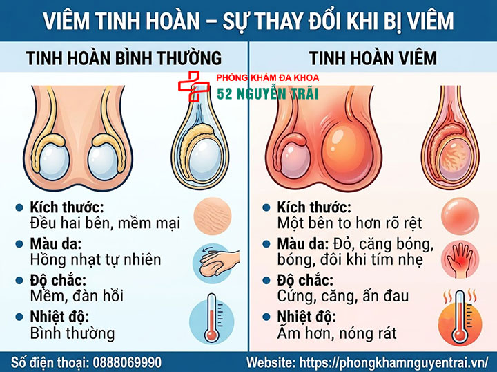 Dấu Hiệu, Triệu Chứng Viêm Tinh Hoàn Cần Biết Sớm 3 Hình Ảnh Mô Tả Viêm Tinh Hoàn – Tinh Hoàn Thay Đổi Ra Sao Khi Bị Viêm?
