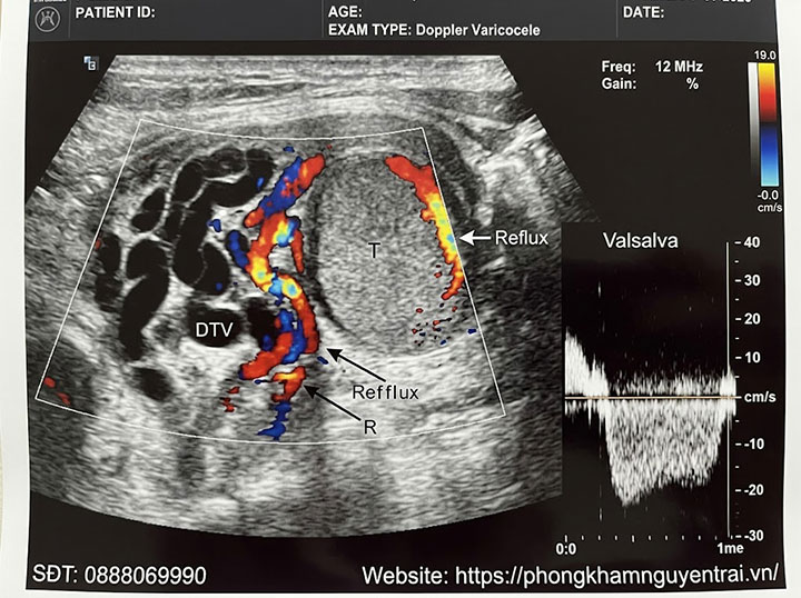 Chẩn Đoán Giãn Tĩnh Mạch Thừng Tinh Bằng Siêu Âm Doppler 1 Hình ảnh giãn tĩnh mạch thừng tinh