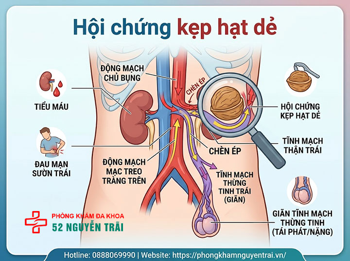 Đau Tinh Hoàn Bên Trái: Nguyên Nhân Và Cách Điều Trị 4 Hội chứng kẹp hạt dẻ