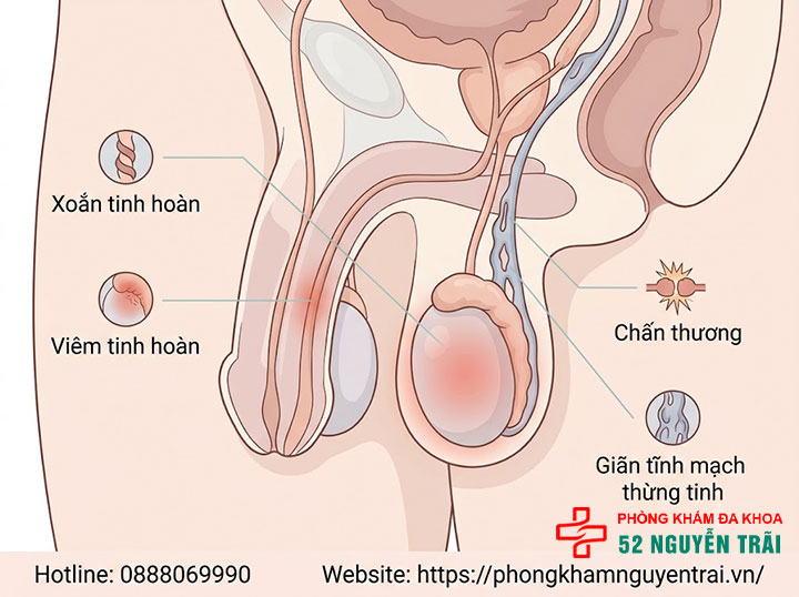 Đau Tinh Hoàn Bên Phải: Nguyên Nhân & Cách Điều Trị 2 Nguyên nhân đau tinh hoàn bên phải
