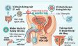 Nguyên nhân gây viêm tuyến tiền liệt ở nam giới