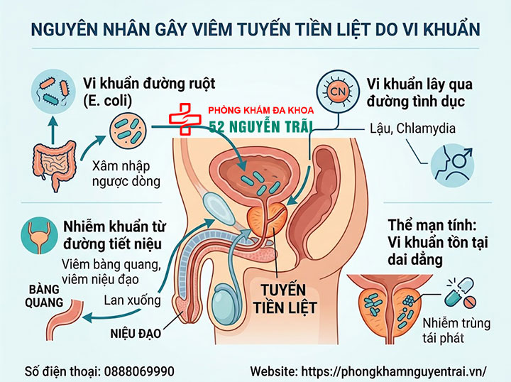 Nguyên nhân gây viêm tuyến tiền liệt ở nam giới 1 Nguyên nhân gây viêm tuyến tiền liệt do vi khuẩn