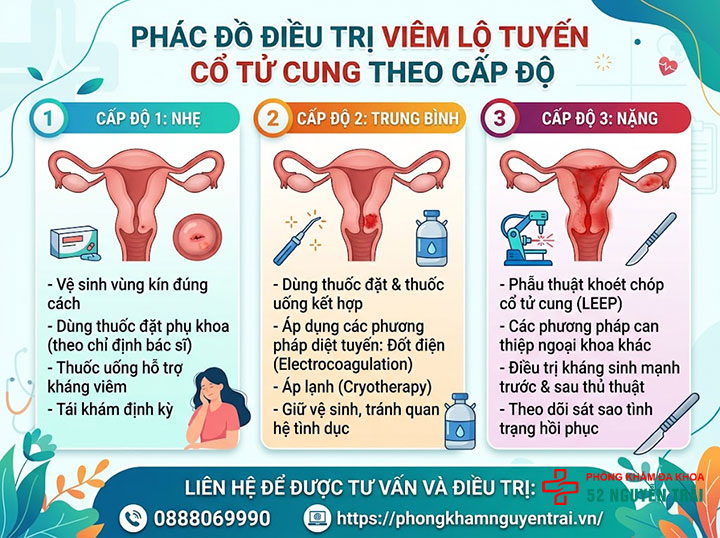Điều Trị Viêm Lộ Tuyến Cổ Tử Cung: Thuốc Và Phác Đồ 4 Phác đồ điều trị viêm lộ tuyến cổ tử cung theo cấp độ (nhẹ / trung bình / nặng)