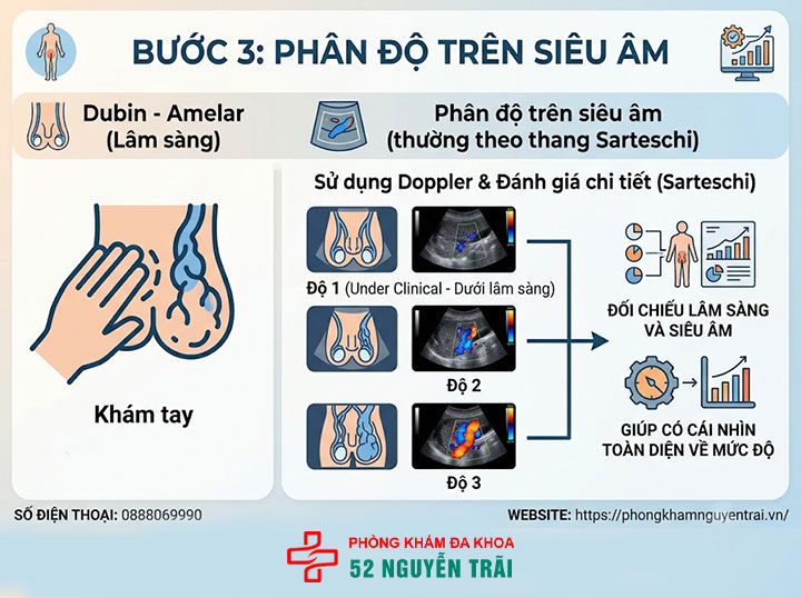 Chẩn Đoán Giãn Tĩnh Mạch Thừng Tinh Bằng Siêu Âm Doppler 4 Phân độ trên siêu âm giãn tĩnh mạch thừng tinh
