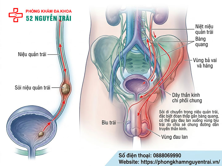 Đau Tinh Hoàn Bên Trái: Nguyên Nhân Và Cách Điều Trị 5 Sỏi niệu quản trái