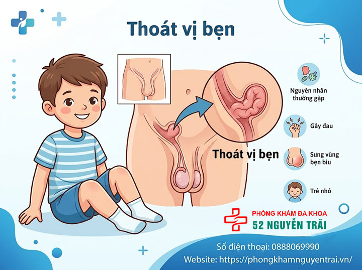 Đau Tinh Hoàn Ở Trẻ Em: Khi Nào Nguy Hiểm, Cha Mẹ Cần Biết 3 Thoát vị bẹn ở trẻ nhỏ