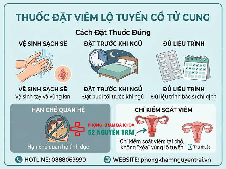 Điều Trị Viêm Lộ Tuyến Cổ Tử Cung: Thuốc Và Phác Đồ 3 Thuốc đặt viêm lộ tuyến cổ tử cung – loại nào hiệu quả, cách đặt đúng