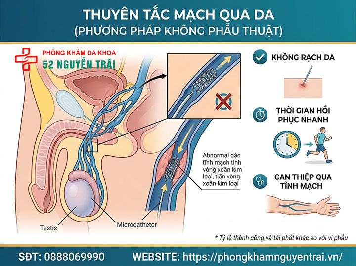 Phẫu Thuật Giãn Tĩnh Mạch Thừng Tinh: Phương Pháp Nào Tốt? 6 Thuyên tắc mạch qua da (phương pháp không phẫu thuật)