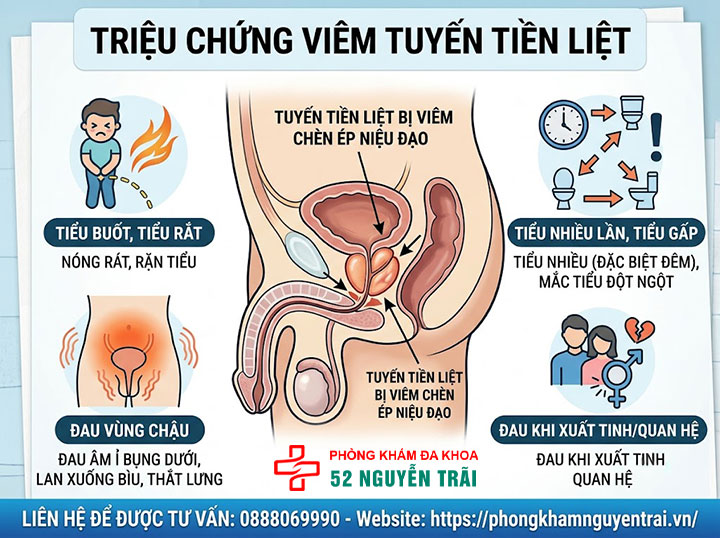 Dấu hiệu viêm tuyến tiền liệt: Nhận biết sớm ở nam giới 1 Triệu chứng điển hình: Tiểu buốt, tiểu rắt, đau vùng chậu
