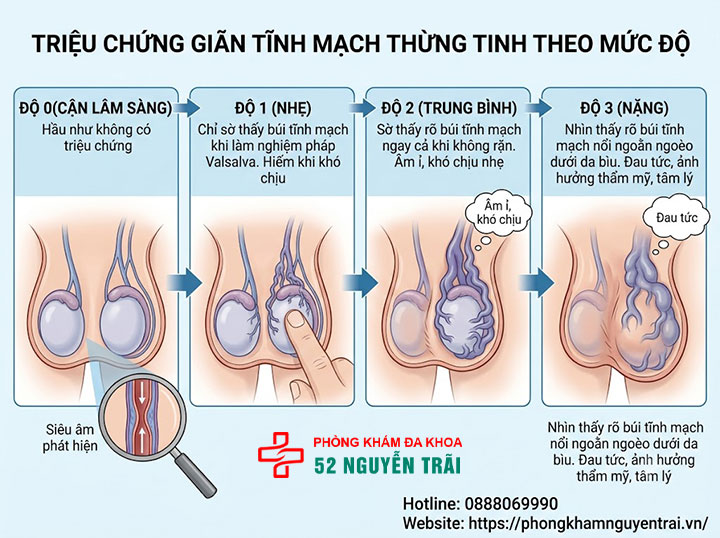 Dấu Hiệu Giãn Tĩnh Mạch Thừng Tinh Cần Nhận Biết Sớm 2 Triệu chứng giãn tĩnh mạch thừng tinh theo mức độ