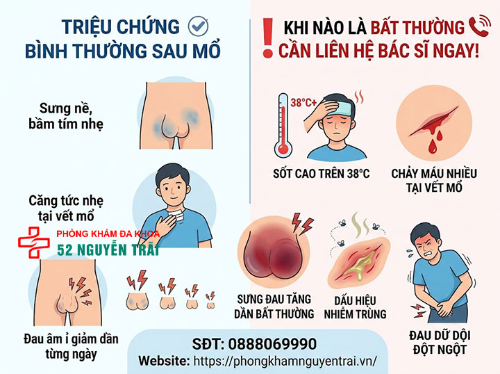Sau Mổ Giãn Tĩnh Mạch Thừng Tinh: Hồi Phục Bao Lâu? 4 Triệu chứng sau mổ giãn tĩnh mạch thừng tinh cần theo dõi và khi nào là bất thường