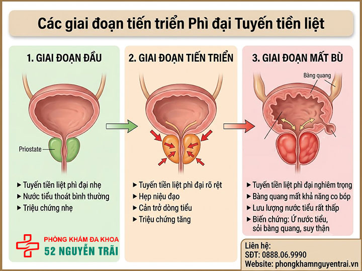 Triệu chứng phì đại tuyến tiền liệt thường gặp nhất 3 Triệu chứng toàn thân và các giai đoạn tiến triển