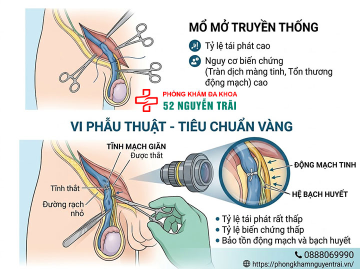 Phẫu Thuật Giãn Tĩnh Mạch Thừng Tinh: Phương Pháp Nào Tốt? 3 Vi phẫu thuật giãn tĩnh mạch thừng tinh