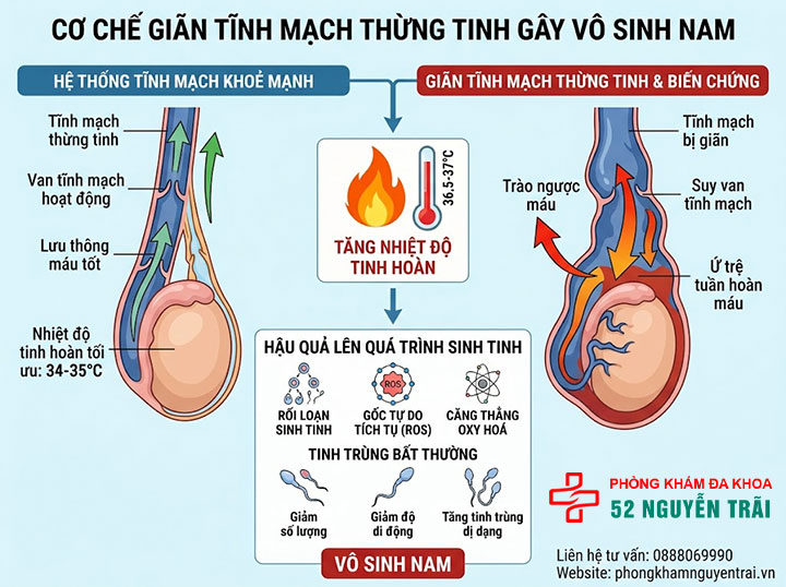 Giãn Tĩnh Mạch Thừng Tinh Có Nguy Hiểm Không? 2 Vì sao giãn tĩnh mạch thừng tinh gây vô sinh?