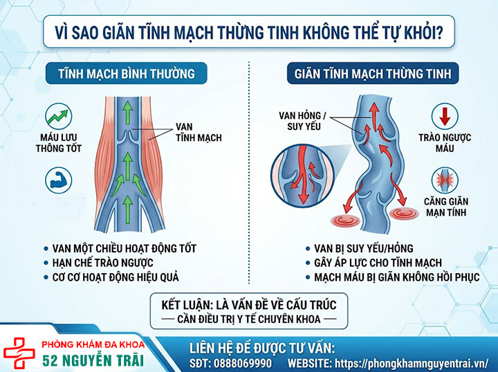 Giãn tĩnh mạch thừng tinh có tự khỏi không? Sự thật bạn cần biết 2 Vì sao giãn tĩnh mạch thừng tinh không thể tự khỏi?