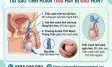 Đau Tinh Hoàn Bên Trái: Nguyên Nhân Và Cách Điều Trị