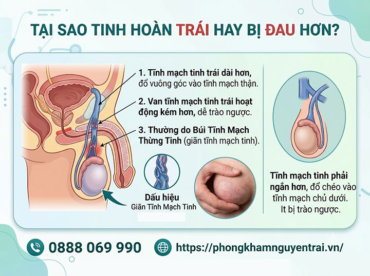 Đau Tinh Hoàn Bên Trái: Nguyên Nhân Và Cách Điều Trị 1 Vì sao tinh hoàn trái hay bị đau hơn?