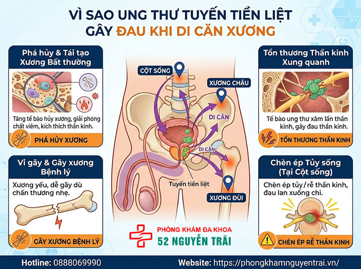 Giảm đau cho bệnh nhân ung thư tuyến tiền liệt di căn xương 1 Vì sao ung thư tuyến tiền liệt gây đau khi di căn xương