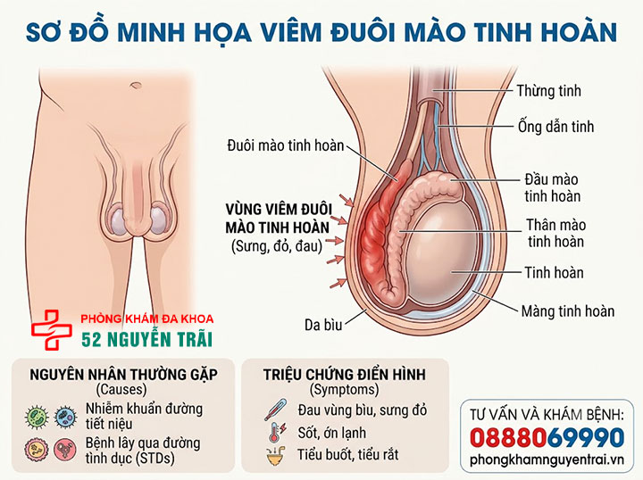 Triệu Chứng Viêm Mào Tinh Hoàn Trái, Phải Cần Biết 4 Viêm Đuôi Mào Tinh Hoàn Là Gì? Nguyên Nhân Và Đặc Điểm Riêng