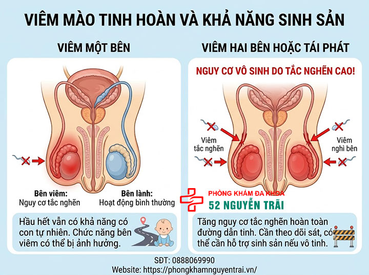 Viêm Mào Tinh Hoàn Có Nguy Hiểm Không? Biến Chứng Gì? 4 Viêm Mào Tinh Hoàn Có Bị Vô Sinh Không? Một Bên Hay Hai Bên?