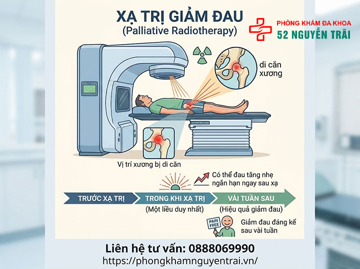 Giảm đau cho bệnh nhân ung thư tuyến tiền liệt di căn xương 4 Xạ trị giảm đau (Palliative Radiotherapy)