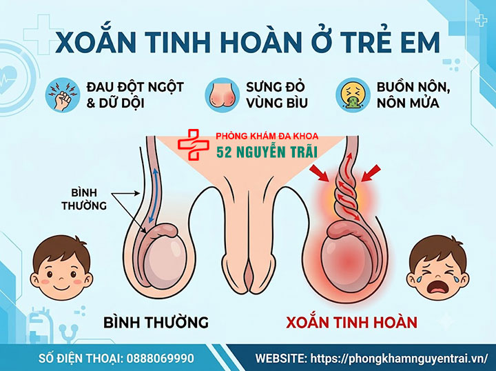 Đau Tinh Hoàn Ở Trẻ Em: Khi Nào Nguy Hiểm, Cha Mẹ Cần Biết 1 Xoắn tinh hoàn ở trẻ