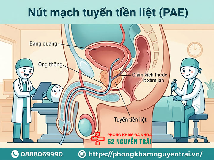Phẫu thuật phì đại tuyến tiền liệt: Phương pháp, chi phí 4 Nút mạch tuyến tiền liệt (Prostate Artery Embolization – PAE)