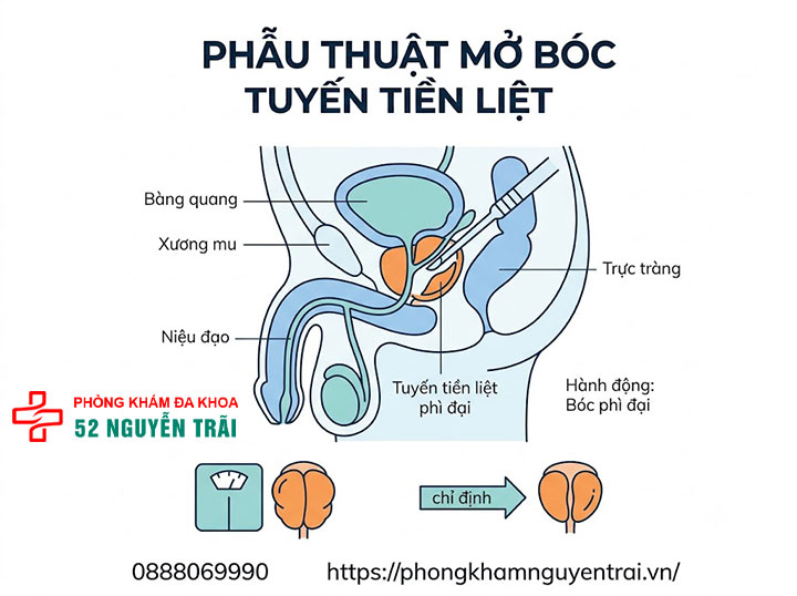 Phẫu thuật phì đại tuyến tiền liệt: Phương pháp, chi phí 5 Phẫu thuật mở bóc tuyến tiền liệt