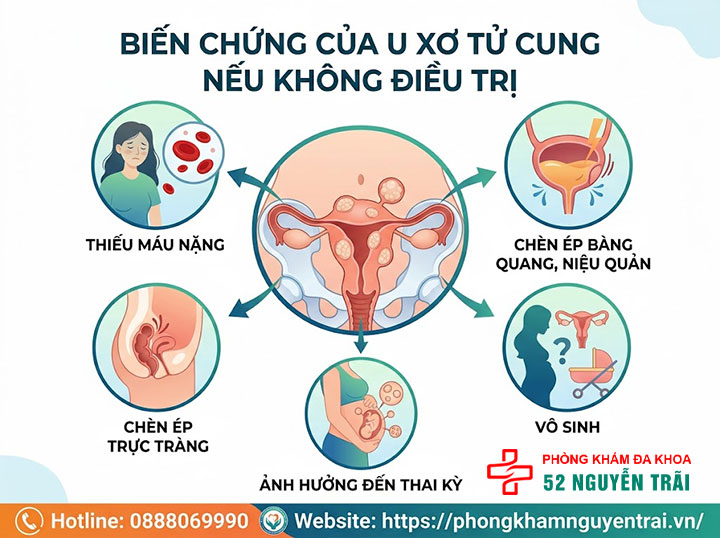 U Xơ Tử Cung Có Nguy Hiểm Không? Biến Chứng Cần Biết 4 Biến chứng u xở tử cung nếu không điều trị: thiếu máu nặng, chèn ép bàng quang, vô sinh