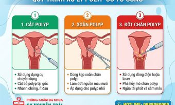 Cắt, Xoắn, Đốt Polyp Cổ Tử Cung: Phương Pháp, Quy Trình