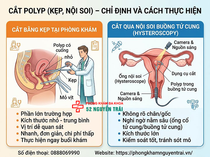 Cắt, Xoắn, Đốt Polyp Cổ Tử Cung: Phương Pháp, Quy Trình 2 Cắt polyp (kẹp, nội soi) – chỉ định và cách thực hiện
