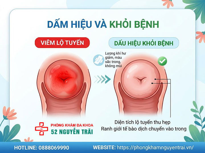 Viêm Lộ Tuyến Cổ Tử Cung Có Nguy Hiểm Không? 6 Dấu hiệu khỏi viêm lộ tuyến cổ tử cung nhận biết khi nào bệnh đã hết