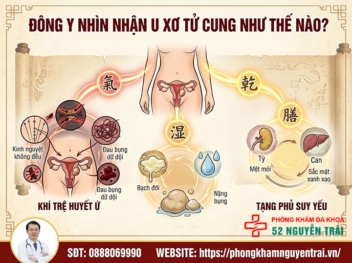 Chữa U Xơ Tử Cung Bằng Thuốc Nam, Đông Y: Hiệu Quả? 2 Đông y nhìn nhận u xơ tử cung như thế nào?