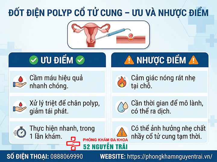 Cắt, Xoắn, Đốt Polyp Cổ Tử Cung: Phương Pháp, Quy Trình 3 Đốt điện polyp – ưu nhược điểm