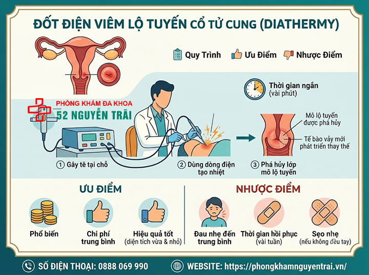 Đốt Viêm Lộ Tuyến Cổ Tử Cung: Phương Pháp, Chi Phí 2 Đốt điện viêm lộ tuyến cổ tử cung