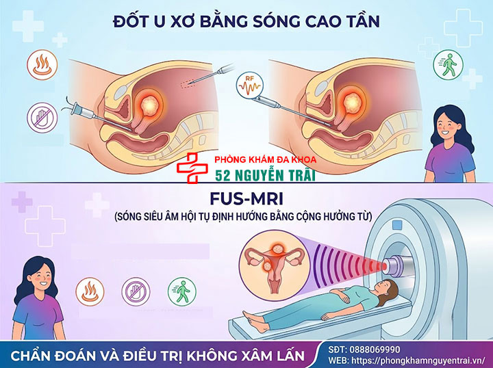 Mổ U Xơ Tử Cung: Các Phương Pháp Và Chi Phí 5 Đốt u xơ bằng sóng cao tần và FUS-MRI