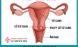 Nguyên Nhân, Triệu Chứng Và Hình Ảnh Polyp Cổ Tử Cung