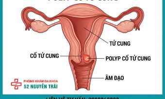 Hình Ảnh Polyp Cổ Tử Cung