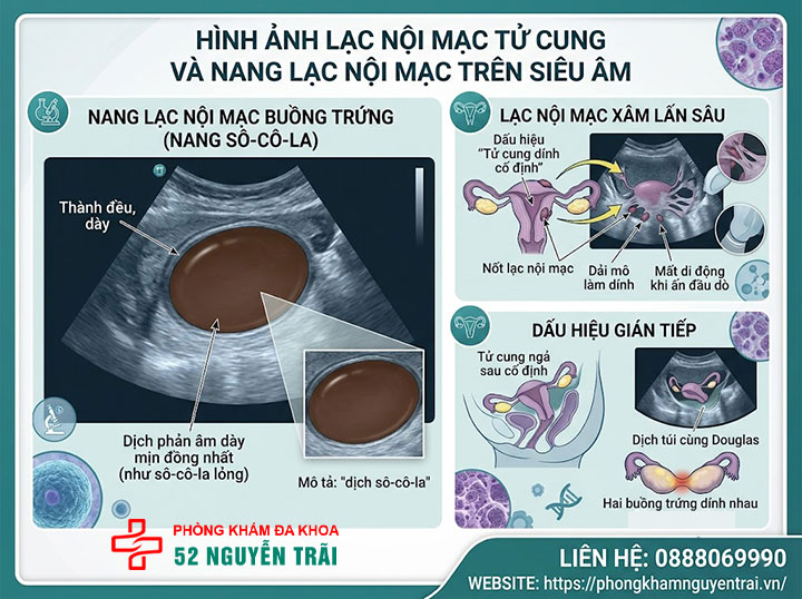 Siêu âm lạc nội mạc tử cung: Phát hiện được không? 3 Hình ảnh lạc nội mạc tử cung và nang lạc nội mạc trên siêu âm trông như thế nào?