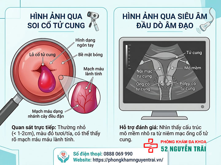 Nguyên Nhân, Triệu Chứng Và Hình Ảnh Polyp Cổ Tử Cung 3 Hình ảnh polyp cổ tử cung qua soi cổ tử cung và siêu âm