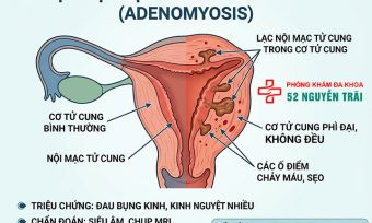Lạc nội mạc trong cơ tử cung: Đặc điểm, triệu chứng và điều trị
