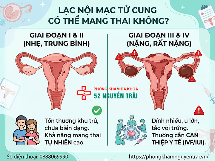 Lạc nội mạc tử cung có thai được không? Giải đáp chi tiết 3 Lạc nội mạc tử cung có thể mang thai không