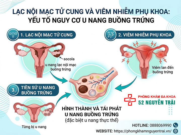 Nguyên nhân u nang buồng trứng và các yếu tố nguy cơ 3 Lạc nội mạc tử cung, viêm nhiễm phụ khoa yếu tố nguy cơ u nang buồng trứng