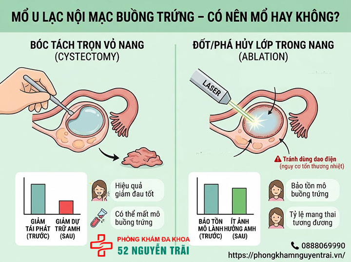 Mổ Lạc Nội Mạc Tử Cung: Khi Nào Cần, Chi Phí 3 Mổ u lạc nội mạc buồng trứng – có nên mổ hay không?
