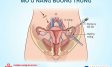Mổ u nang buồng trứng: Khi nào cần, quy trình, chi phí