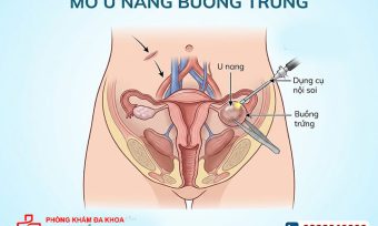 Mổ u nang buồng trứng