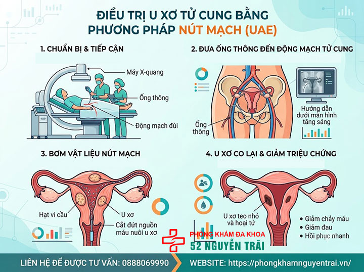 Mổ U Xơ Tử Cung: Các Phương Pháp Và Chi Phí 4 Nút mạch u xơ tử cung (UAE): nguyên lý, ai phù hợp