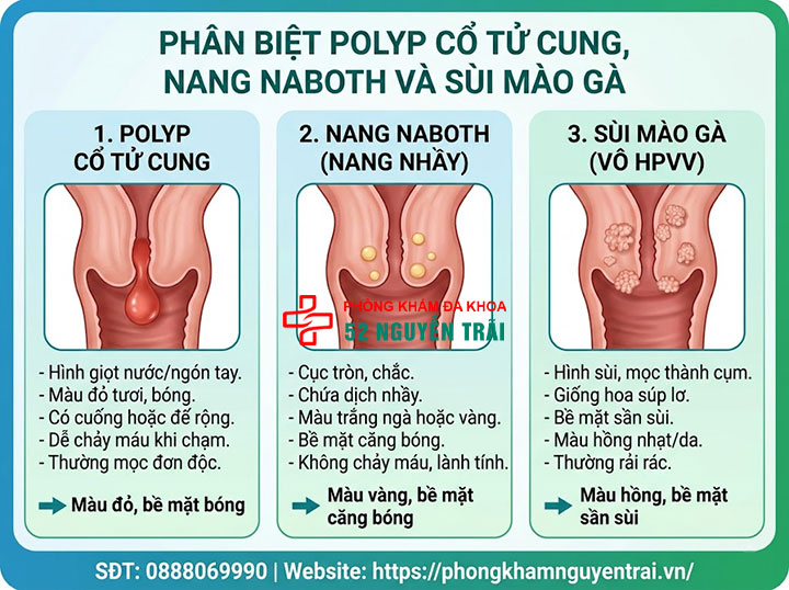Nguyên Nhân, Triệu Chứng Và Hình Ảnh Polyp Cổ Tử Cung 4 Phân biệt polyp cổ tử cung với sùi mào gà, u nang (nang Naboth)