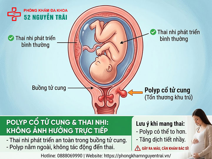 Polyp Cổ Tử Cung Khi Mang Thai Có Nguy Hiểm Không? 2 Polyp cổ tử cung ảnh hưởng đến thai nhi như thế nào?