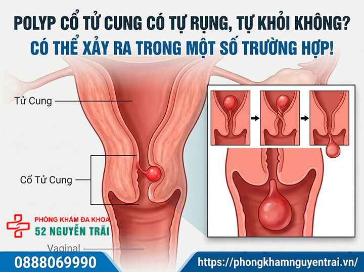 Polyp Cổ Tử Cung Có Nguy Hiểm Không? Có Nên Cắt? 3 Polyp cổ tử cung có tự rụng, tự khỏi không?